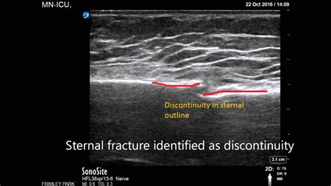 Sternal Fracture Precautions