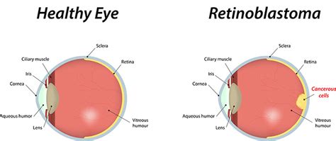 Retinoblastoma