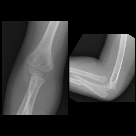 Pediatric Monteggia Fracture Dislocation | Pediatric Radiology Reference Article | Pediatric ...