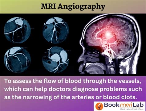 MRI Angiography Price, Purpose, Procedure, Results [2025]