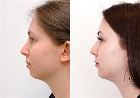 Chin Implant Before & After Gallery | Dr. Cory Torgerson