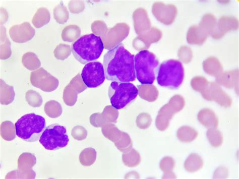 How Acute Myeloid Leukemia Is Diagnosed