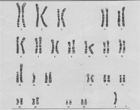 Karyotype of the patient which shows Turner syndrome with... | Download Scientific Diagram