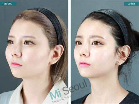 Zgyoma Cheekbone Reduction Korea