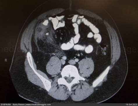 STOCK IMAGE, ct scan axial section showing a right lower quadrant ...