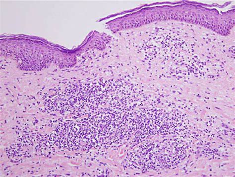 Histopathology reveals multiple non-caseous epithelioid cell granulomas ...