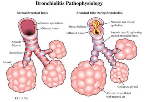 Pediatric Pearls – Bronchiolitis – St. Joseph's Health Center ...