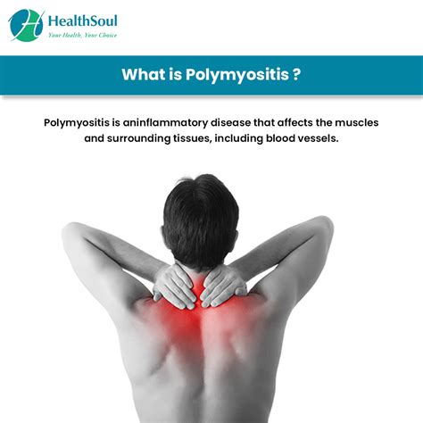 Polymyositis – Causes, Symptoms, Diagnosis, Treatment – Healthsoul