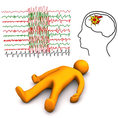 Epilepsy - Net Health Book