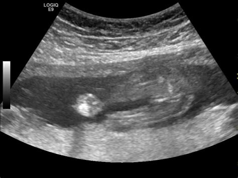 19 week ultrasound- girl? | BabyCenter