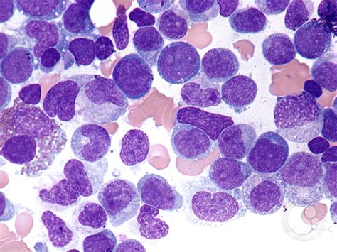 Acute myelomonocytic leukemia - 3.