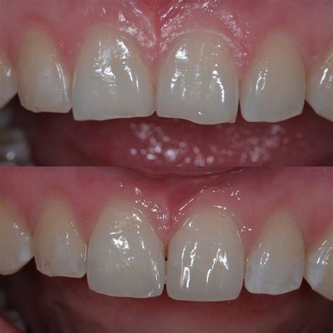 Gallery - Composite Resins Bonding - Uptown Guelph Dental