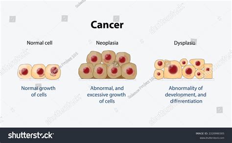 Normal Cells Dysplasia Abnormality Development Differentiation Stock Vector (Royalty Free ...