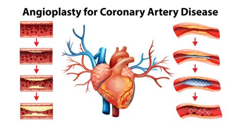 Angioplasty Surgery Cost in Mumbai | Coronary Angioplasty