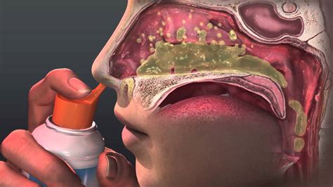 Nasal Irrigation Sinus Rinse Diagram