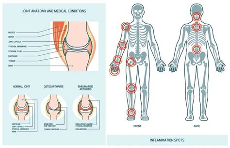 Osteoarthritis Treatment - Returning to Healthy Joint Function - SpineOne