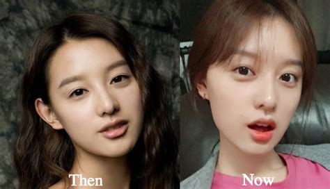 Kim Ji Won Plastic Surgery Before and After Photos