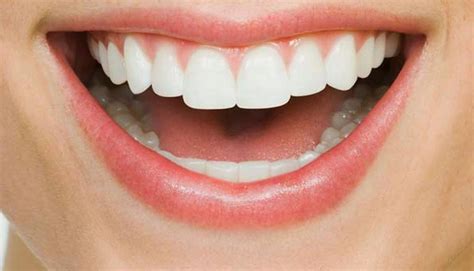 Different types of teeth whitening