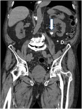 Normal Ct Scan Abdomen