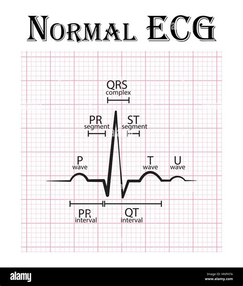 Normal ECG ( Electrocardiogram ) ( P wave , PR segment , PR interval , QRS complex , QT interval ...