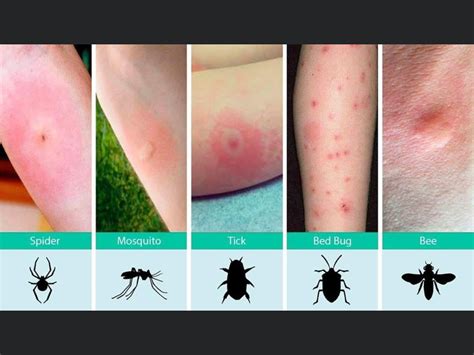 Types of bug bites in bed - nerydial