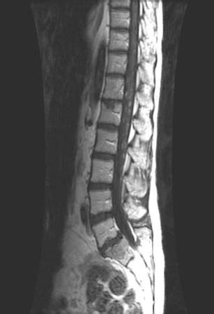 Malignant Spinal Cord Compression | Musculoskeletal Key