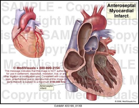 Anteroseptal Myocardial Infarct Medical Illustration Medivisuals