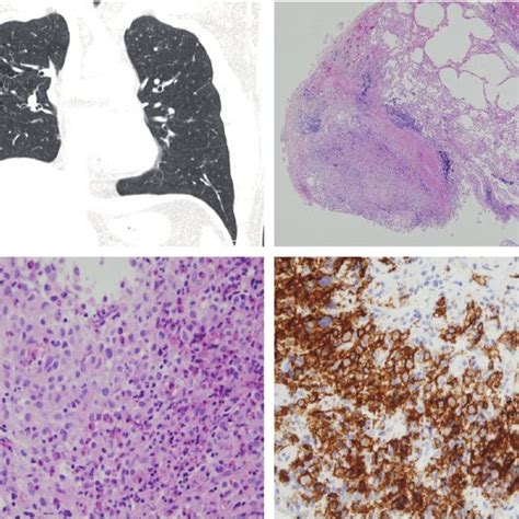 (PDF) Diagnosis and treatment of cystic lung disease