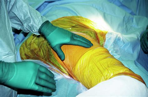 Hip Replacement Surgery Photograph by Antonia Reeve/science Photo Library