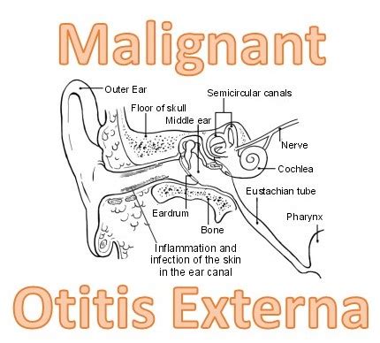 emDOCs.net – Emergency Medicine EducationMalignant Otitis Externa ...