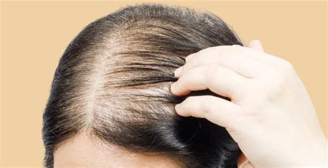 Thinning Hair in Women & Hair Loss: Advice and Reasons – Equi Botanics