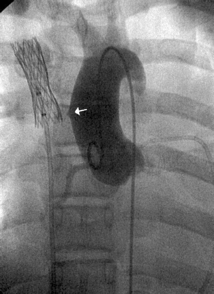 Late Superior Vena Cava Perforation and Aortic Laceration After Stent Placement for Treatment of ...