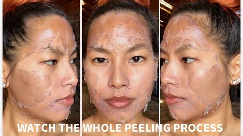 WATCH WHAT HAPPENS AFTER YOU GET A PEEL ( 7 DAY PEEL PROCESS) - YouTube