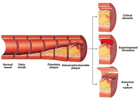 Pathophysiology of Atherosclerosis – Pathology