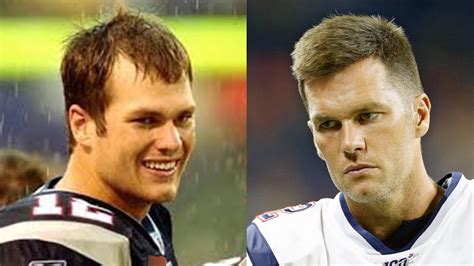 Tom Brady Hair Transplant + Plastic Surgery or Not? Reaction to MPMD ...