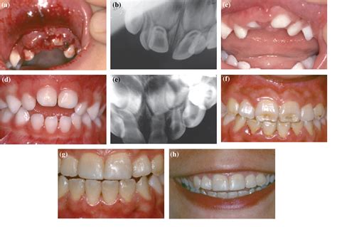 Figure 2 from Intrusive luxation of primary teeth. | Semantic Scholar