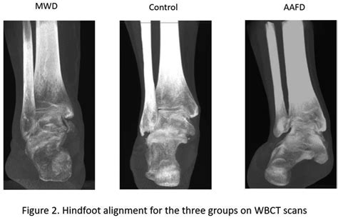 Hindfoot Varus Deformity: An Essential but Easily Neglected Pathological Change in Müller-Weiss ...