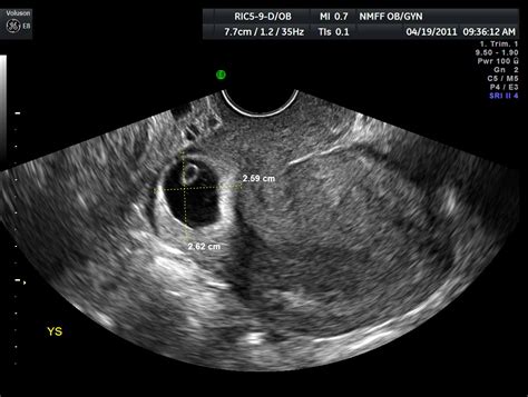 Normal Uterus Measurements Ultrasound