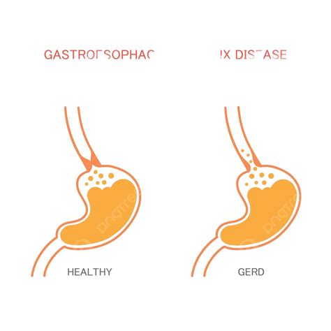 Refluxdisease Gastric Abdomen Heart Vector, Gastric, Abdomen, Heart PNG and Vector with ...