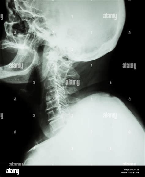 Cervical spondylosis . Film x-ray of cervical spine ( lateral position ) ( side view Stock Photo ...