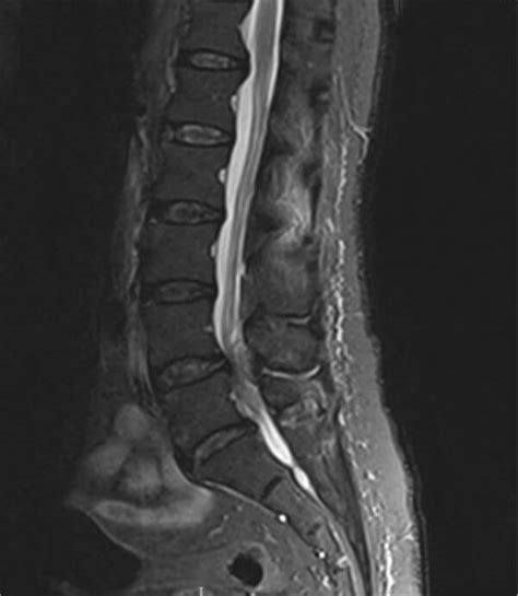 Cauda Equina Syndrome (CES) | Geeky Medics