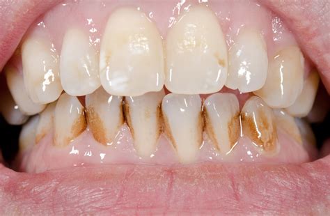 5 cibi che inaspettatamente causano danni ai nostri denti | P. by ...