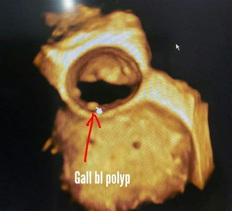 Ultrasound imaging: Gall bladder polyp 3D ultrasound