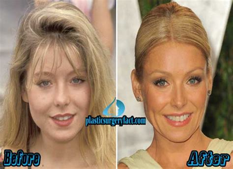 Kelly Ripa Plastic Surgery Before and After Pictures