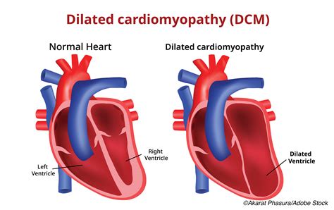 Genetic Profile Refines Risk of SCD in Patients with Left Ventricular ...