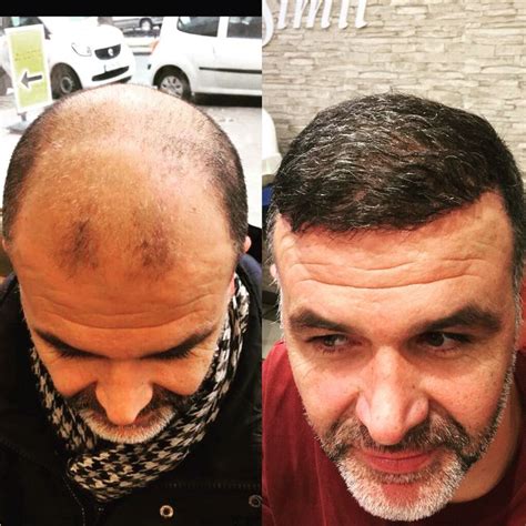 Hair Transplant Turkey - Hair Transplant Istanbul - Turkey Hair Restoration | Saç, Saç bakımı ...