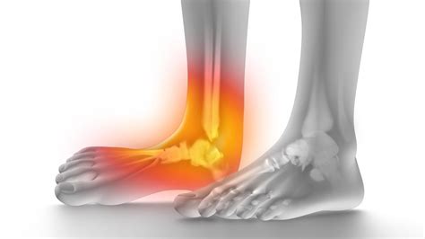 Chronic Ankle Instability: Surgery And Other Treatments