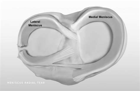 Medial and Lateral Torn Meniscus Repair Surgery | Dr Fayaz Memon