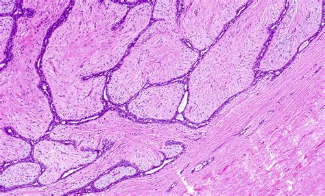 Types Fibroadenoma With Cell Changes