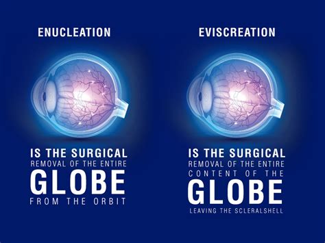 Enucleation & Evisceration at orbit eye hospital mumbai